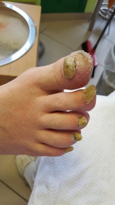 Crazy-feet Crazy-feet