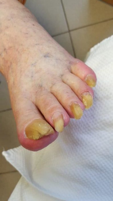 Crazy-feet Crazy-feet