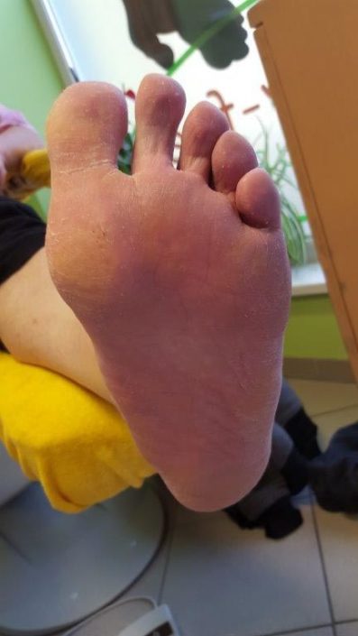 Crazy-feet Crazy-feet