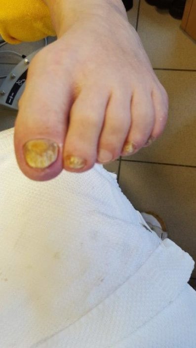 Crazy-feet Crazy-feet