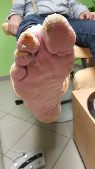 Crazy-feet Crazy-feet