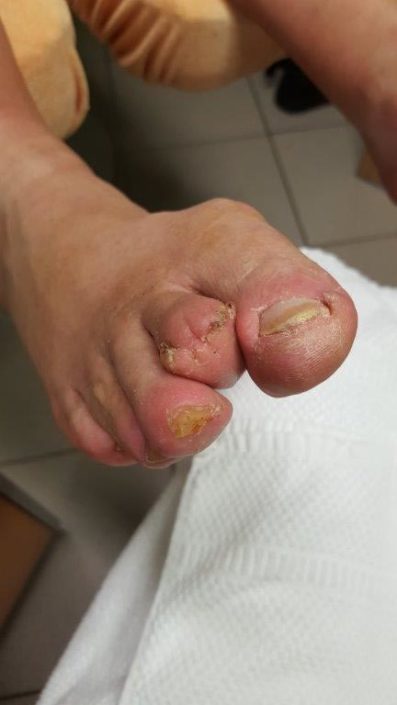 Crazy-feet Crazy-feet