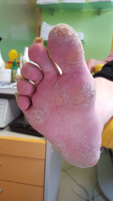 Crazy-feet Crazy-feet